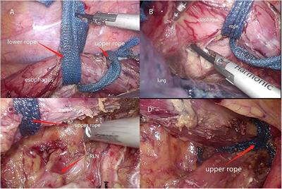 Two-rope method for dissecting esophagus in McKeown MIE